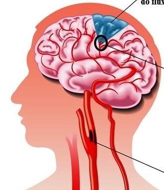 Acidente Vascular Cerebral É uma síndrome neurológica complexa envolvendo anormalidade usualmente súbita do