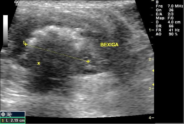 No exame ultrassonográfico foi possível visibilizar centralmente a bexiga com intensa região hipercóica (linha amarela) e com sombra acústica projetada logo abaixo (Figura 2).