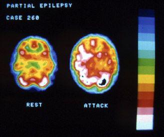 Raios Gama 15 No SPECT (Single Photon Emission computed Tomography) uma pequena