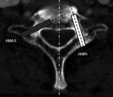 O diâmetro interno do pedículo (DIP) foi medido em milímetros entre a cortical interna e externa do pedículo, na região de menor largura (Figura 1).