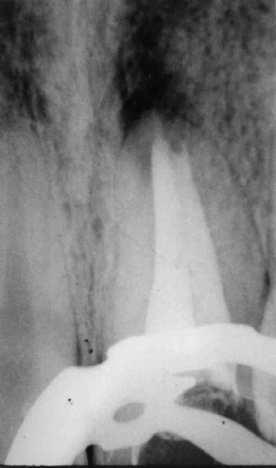 Revista de Endodontia Pesquisa e Ensino On Line - Ano 2, Número 3, Janeiro/Junho, 2006. 6 Discussão e conclusão: Na macrodontia, como já foi citado de dente com geminação.