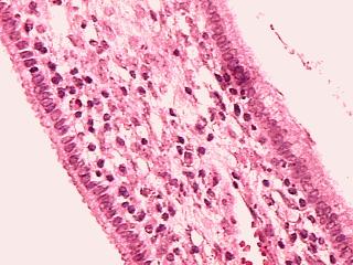 HE 4 x Mucosa endocervical original Mostra revestimento de epitélio colunar simples. (Fonte: pró-célula, 2014). A endocérvice inicia-se no orifício anatômico interno por continuidade com o endométrio.