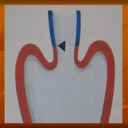 apud, CREMASCO, 2005) A eversão ocorre quando a mucosa endocervical invade a ectocervice, expondo a mucosa glandular muito frágil ao agressivo meio vaginal.
