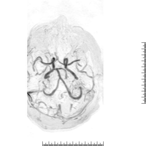 Arm Cerebral Arterial 3D c/ Gadolínio PARÂMETROS Arterial 3D c/ Gadolinio Flip angle: 45 graus; TR: Min; TE: Min; Plano: Obliquo FOV: 24cmX18cm; 36 cortes;