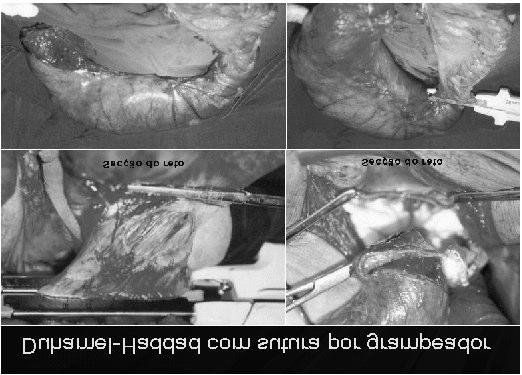 19 Figura 02 Sete dias após a cirurgia abdominal os pacientes foram submetido a anastomose