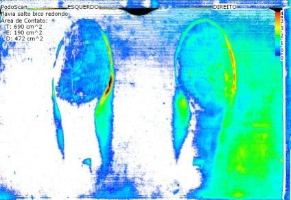 Ainda nestas imagens verificamos o lado de maior contato do pé do indivíduo I (Figura 5) e indivíduo II (Figura 6), de acordo com ao arco longitudinal medial demonstrando, respectivamente, a presença