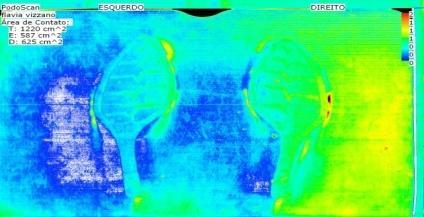 A Figura 9 e a Figura 10 representam os indivíduos utilizando um salto inteiriço, tipo anabela, em que a distribuição da área de contato é bem parecida com a do indivíduo descalço por apresentar