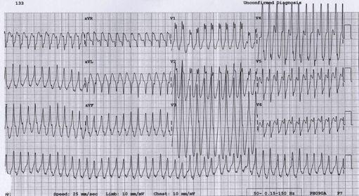 (&%J+ Via Ortodrómica QRS normal sem