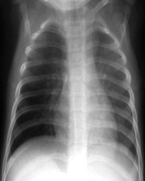 Estudo de Caso Radiografia mostra? Qual é o diagnóstico mais provável?