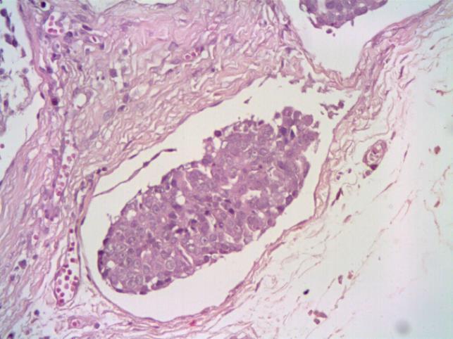 Dentre os animais que apresentaram metástase em linfonodo axilar (Figuras 5 e 6) e inguinal concomitantemente, um deles apresentava tumoração (Carcinoma Simples Túbulopapilar) apenas na mama inguinal