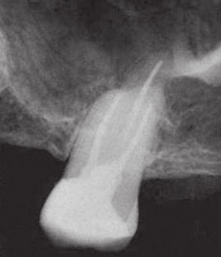 O exame clínico revelou a presença de extenso tecido cariado sem evidente comprometimento periodontal. O exame radiográfico confirmou a proximidade do tecido cariado com a polpa coronária.