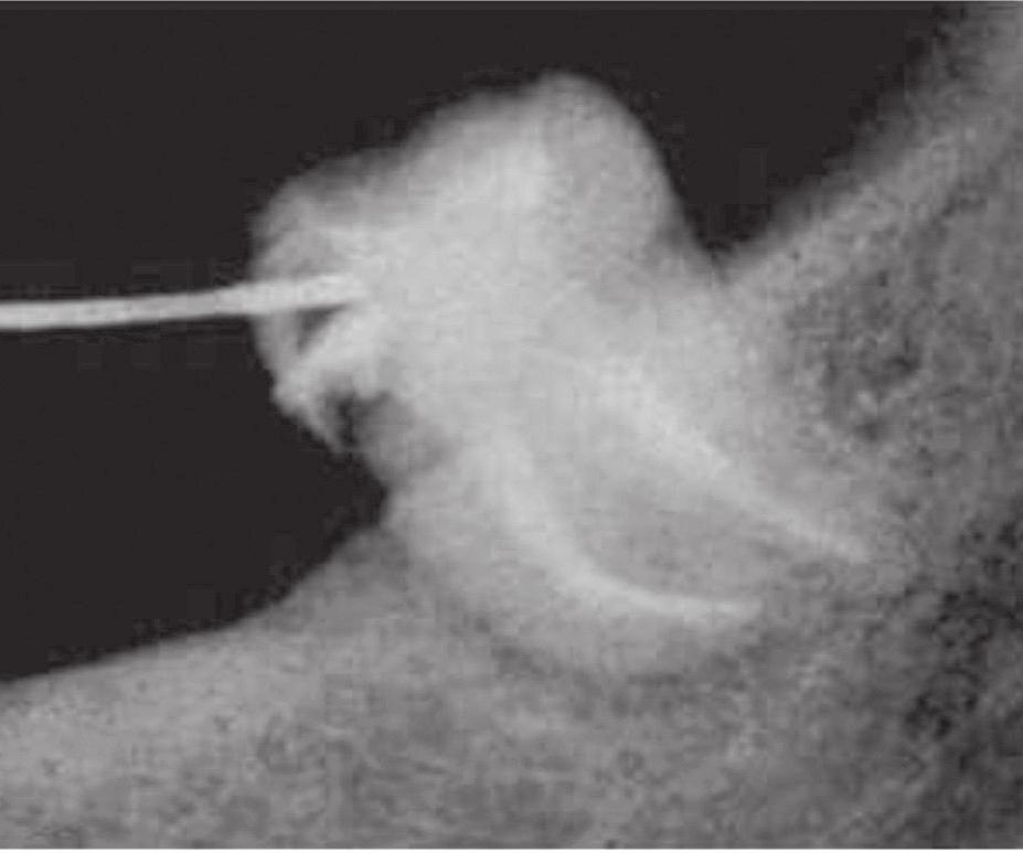 854 canais tratados, foram observados 38 instrumentos fraturados em diferentes grupos dentais. maior incidência de fraturas ocorreu nos terços apicais de molares com canais curvos e/ou atrésicos.