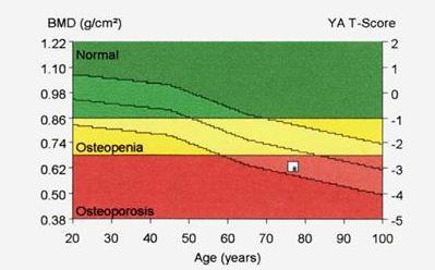 Rastreamento e diagnóstico da osteoporose Densitometria óssea: padrão-ouro para diagnóstico T Escore Normal > -1 Osteopenia -1 a -2.