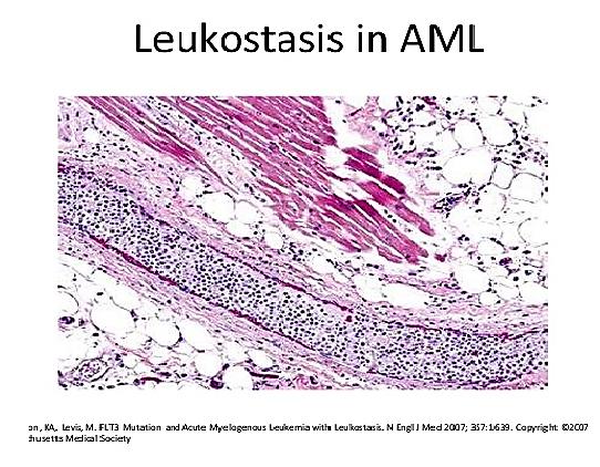 Leucostase The morphological evidence of in É a evidência morfológica intravascular do acúmulo dos blastos