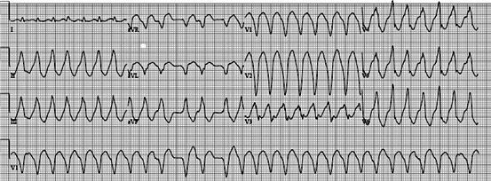 Vem ao ambulatório com queixa de dor precordial aos esforços habituais há cerca de um mês, além de astenia e tontura há 20 dias.