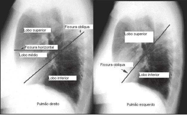 AE átrio esquerdo; AO arco aórtico; PU artéria pulmonar; VD Ventrículo direito; VE ventrículo esquerdo. Figura 3.
