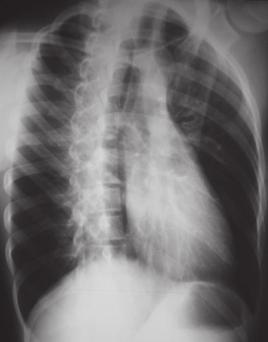 A incidência AP é geralmente obtida com uma unidade de raios X portátil, em pacientes acamados ou em crianças, sendo realizada com a colocação do filme no dorso do paciente, e os feixes de raios X
