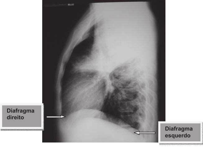 Lauand LSL, Souza Junior EB, Andrade BJ, Sprovieri SRS. Contribuição da interpretação da radiografia simples de tórax na sala de emergência. Arq Med Hosp Fac Cienc Med Santa Casa São Paulo.