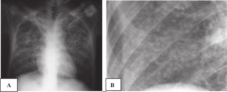 Os contornos das opacidades são mal definidos, exceto no ponto de contato com a pleura, sendo possível a identificação de broncogramas aéreos (figura 12) 7,10.