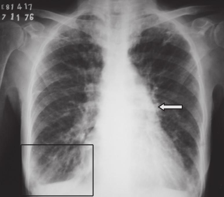 O interstício é uma rede de tecido conectivo que dá suporte aos pulmões e normalmente não é visível na radiografia simples de tórax 10.