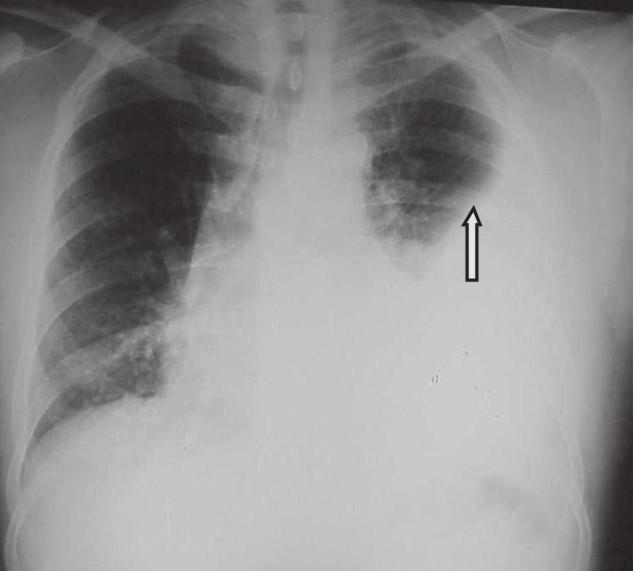 As linhas delimitam área de diminuição de densidade pulmonar devido a um TEP. As atelectasias e as afecções pleurais serão descritas mais adiante.