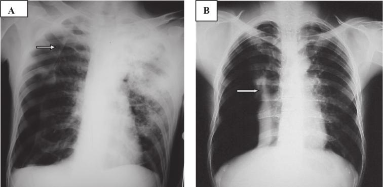 Nos casos de pneumotórax de pequeno volume é útil a realização da radiografia expirada para facilitar a visualização da linha da pleura visceral 13.