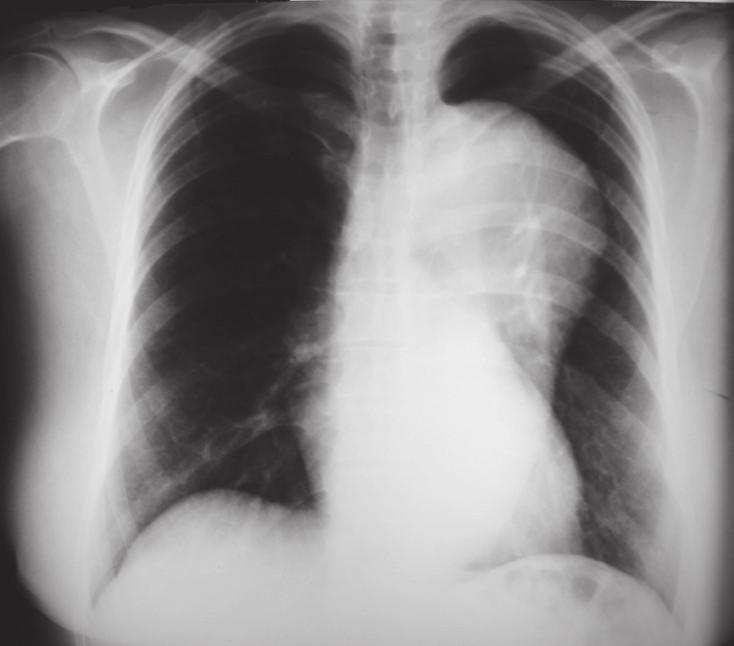 O sinal do sulco profundo é um importante sinal, visto que pode ser o único indício da presença de ar no espaço pleural 13.