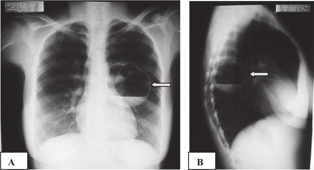 Caracteriza-se através da imagem radiográfica do tórax por uma dilatação proximal de um vaso embolizado, associado ao colapso dos vasos distais 16.