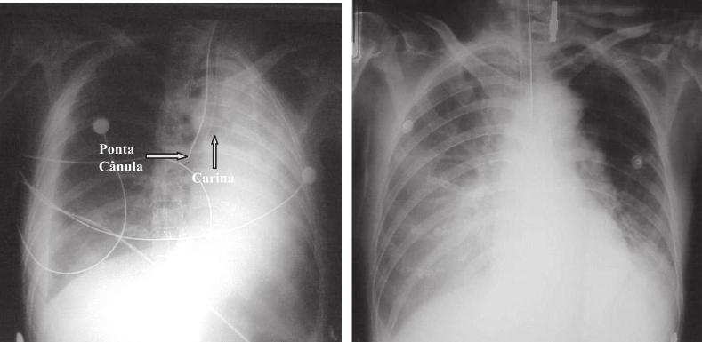Em A é possível a visualização de um infiltrado micronodular em um caso de tuberculose miliar, em B é visto infiltrado alveolar em ambos os ápices pulmonares, com áreas de cavitação e estrias