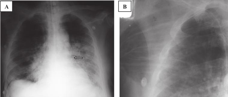 Intubação seletiva A radiografia evidencia o tubo muito introduzido na via aérea, geralmente localizado no brônquio fonte direito.