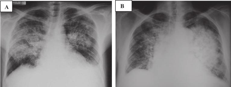 Podem existir enfisema subcutâneo e pneumotórax no hemitórax ventilado 11. Radiografia que evidencia ar dissecando o tecido celular subcutâneo.