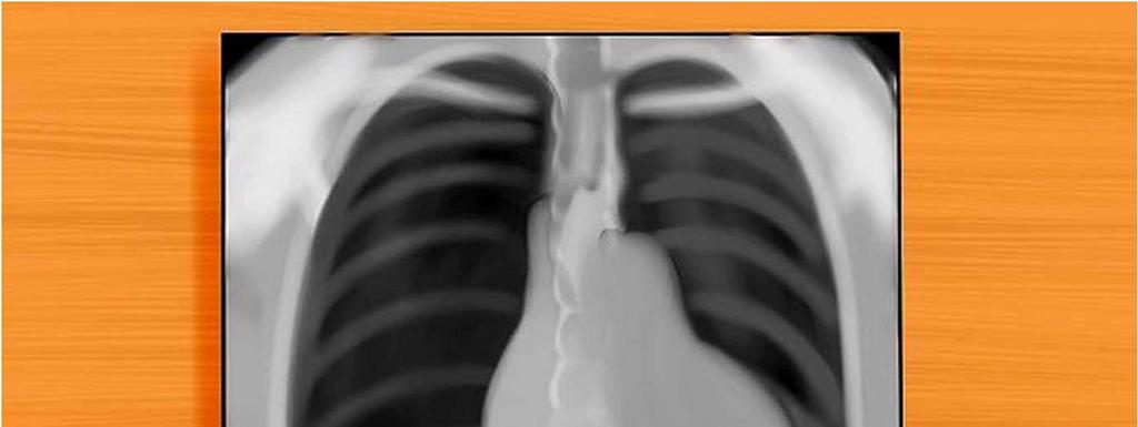 coração. Verifique o coração. Examine as bordas do órgão; Se as margens da silhueta estão nítidas.