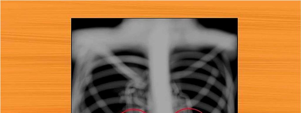 6 Observe os hilos. Procure por nódulos e massas nos hilos dos dois pulmões. Na visão frontal, a maioria das sombras dos hilos representa as artérias pulmonares, direita e esquerda.
