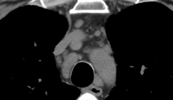 A Radiografia de tórax com incidência PA, mostra uma massa no mediastino superior, paratraqueal direita, com limites mal definidos acima do nível das clavículas.