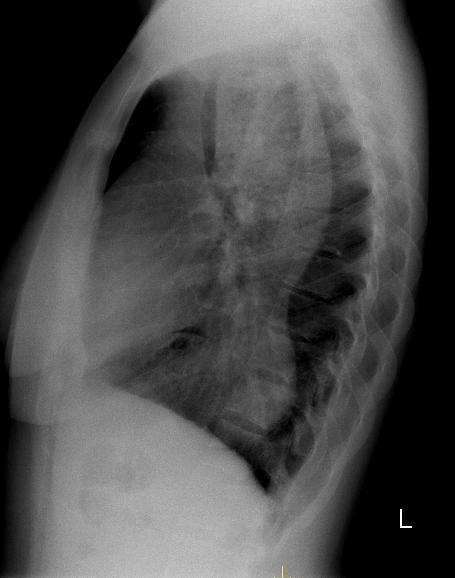 A Radiografia do tórax com incidência PA mostrando opacidade em toalha homogénea ocupando todo o campo pulmonar esquerdo e condicionando sinal de silhueta com o