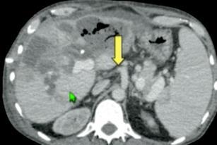 Resultados na trombose arterial Sucesso da