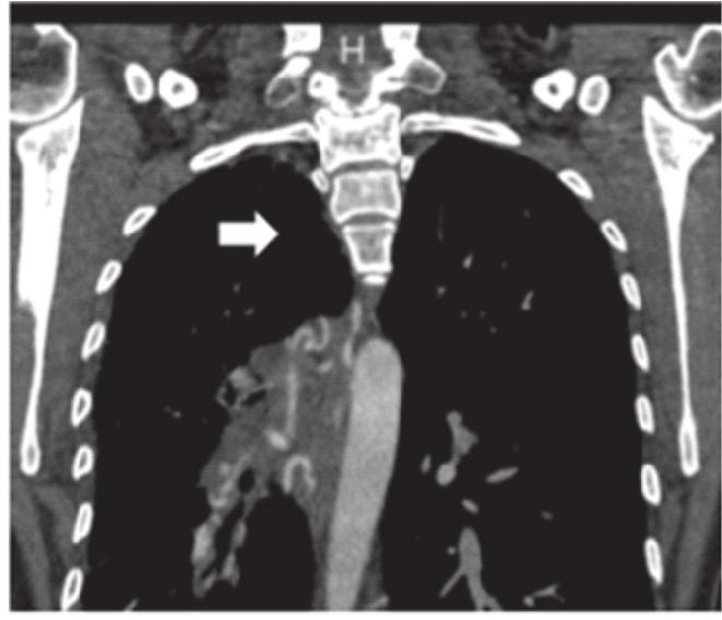 Acredita-se que resulta da falha de incorporação da veia pulmonar comum no átrio esquerdo, podendose observar, em alguns casos, remanescentes fibróticos, prováveis resquícios embrionários,