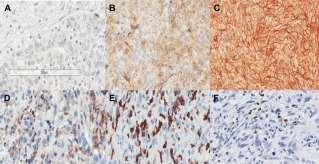 Racional para Imunoterapia em Mesotelioma Fenótipo inflamatório (Células T) e expressão de PDL-1 pelas células tumorais de mesotelioma: 20-40% dos casos Sarcomatóide > Bifásico > Epitelióide