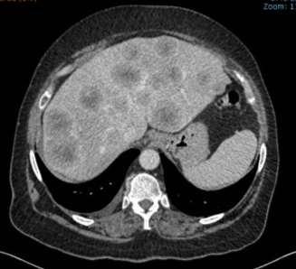 Carcinoma de pulmão de células pequenas, doença