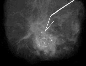 Cericatto et al. Manejo das lesões mamárias impalpáveis Figura 2. Agulhamento de microcalcificações agrupadas e pleomórficas, BIRADS 5: AP = carcinoma ductal in situ.