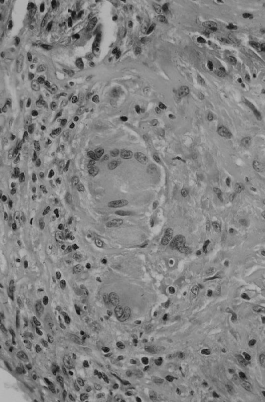 espaços alveolares corpos de Shaumman (48% 88%) corpos asteróides (2% 9%) vasculite granulomatosa