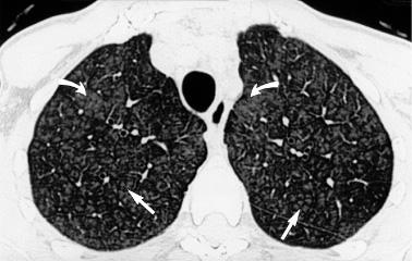 inflamação linfoplasmocitária raros eosinófilos