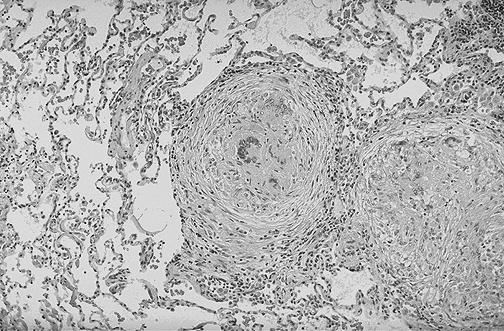 Classificação da reação granulomatosa Distribuição (clínico-radiológica) traqueobrônquica nodal pleural parenquimatosa angiocêntrica Necrosante e não necrosante Qualidade da necrose fibrinóide