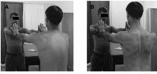 A diminuição da RM do ombro desses atletas, que ocorre devido à contratura da cápsula posterior, pode causar impacto posterointerno, impacto subacromial e desequilíbrio muscular, tendo como