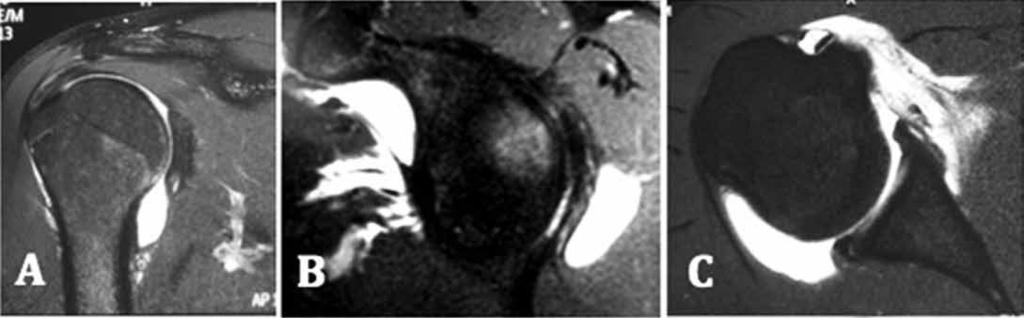 234 Figura 7 Caso 1: Imagem de artrorressonância magnética do ombro direito do atleta que não obteve melhora da dor com o programa de reabilitação; (A) corte coronal em T2, mostrando lesão do lábio