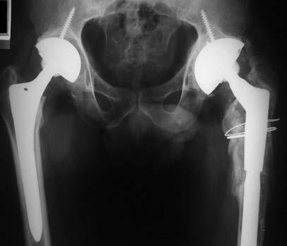 componente proximal, facilitando a correção de anormalidades anatômicas do fêmur ou de posicionamento do acetábulo e aumentando a estabilidade do implante, no qual a conexão é feita em cone morse com