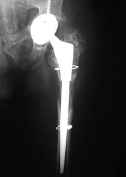 osteossíntese do fêmur submetido a osteotomia trocantérica estendida com um ou dois cabos de aço, posicionamento do dreno de sucção e sutura da ferida.