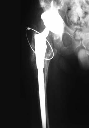 B) Controle radiográfico pós-operatório com perda óssea proximal extensa, sendo apenas fixado trocanter maior com um cabo de aço.