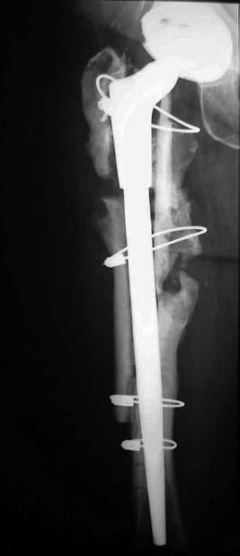 evoluíram com falha mecânica apresentavam perdas ósseas Paprosky IIIB e IV; nenhum paciente com perdas ósseas II e IIIA evoluiu com perda de fixação.