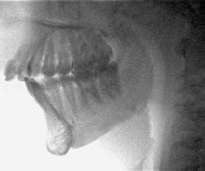 Avaliação da inclinação do incisivo inferior através da tomografia computadorizada 1 90,1º FIGURA 3 - Reformatação primária plano mandibular.